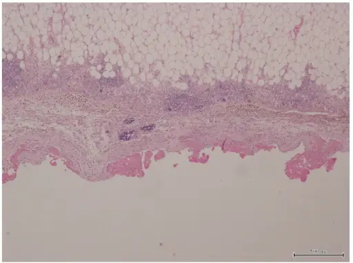 Pericarditis