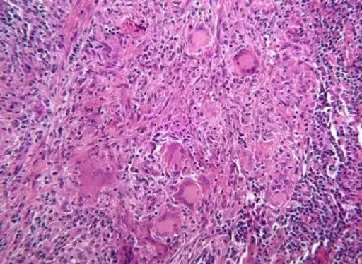 Peripheral Giant Cell Granuloma