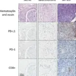 Peripheral Nerve Sheath Tumors