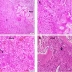 Peripheral Ossifying Fibromas