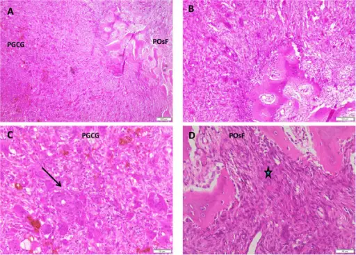 Peripheral Ossifying Fibromas