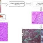 Peritoneal Cavity Infections