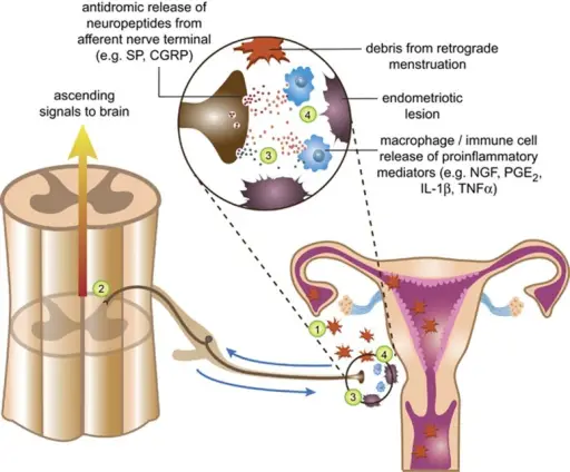 Peritoneal Cavity Inflammatory Disease