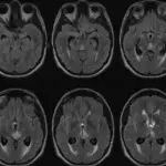 Periventricular Mass Lesions