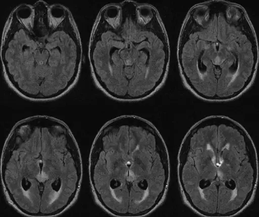 Periventricular Mass Lesions