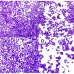 Pertussis bacterial infection