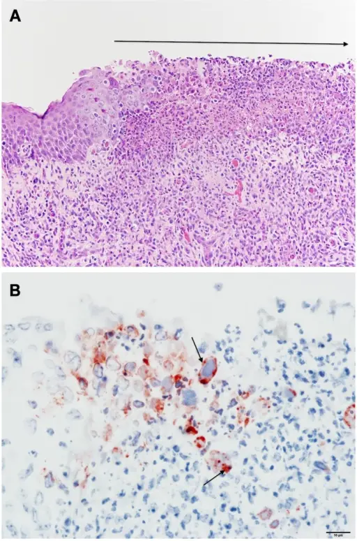 Pharyngitis