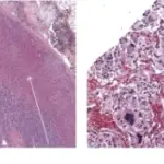 Pheochromocytoma