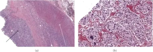 Pheochromocytoma