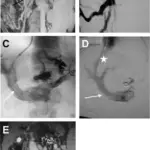 Phlebothrombosis