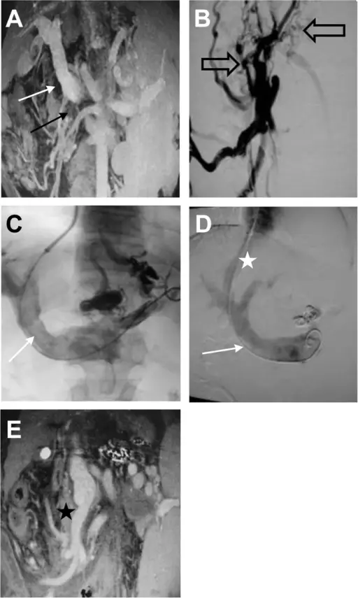 Phlebothrombosis