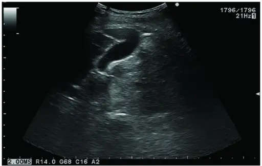 Phrygian Cap of the Gallbladder