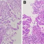 Pineal Parenchymal Tumors