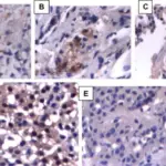 Pituitary Adenoma