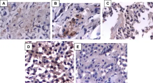 Pituitary Adenoma