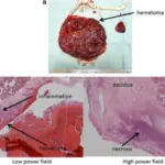 Placental Infections