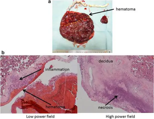 Placental Infections