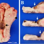 Placental Site Trophoblastic Tumor