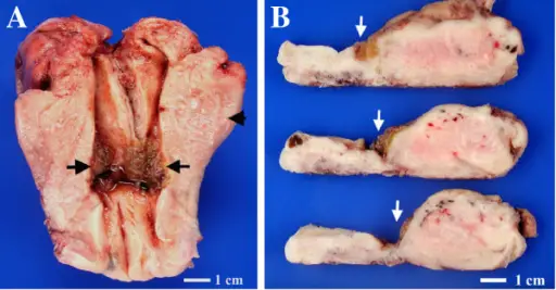 Placental Site Trophoblastic Tumor