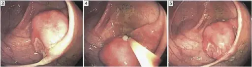 Plasmacytoma Endoscopy Pathosomes