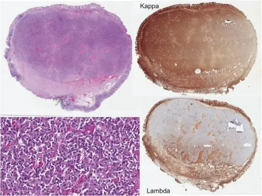 Plasmacytoma Histology