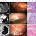 Pleural Effusions