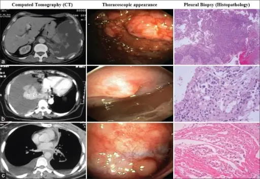 Pleural Effusions