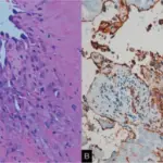 Pleural Lesions