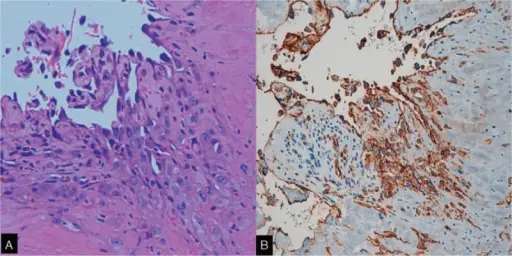 Pleural Lesions