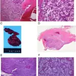 Pleural Tumors