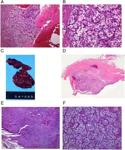 Pleural Tumors