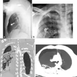 Pneumothorax