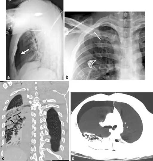 Pneumothorax