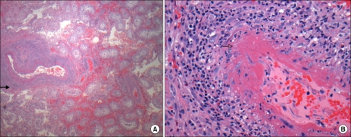 Polyarteritis Nodosa