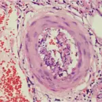 Polyarteritis Nodosa Histology