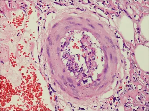 Polyarteritis Nodosa Histology