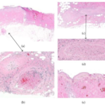 Polyarteritis Nodosa