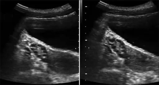 Polycystic Ovaries