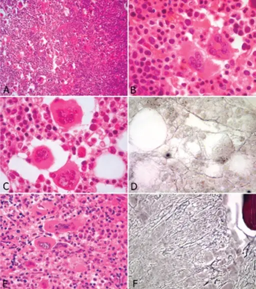 Polycythemia