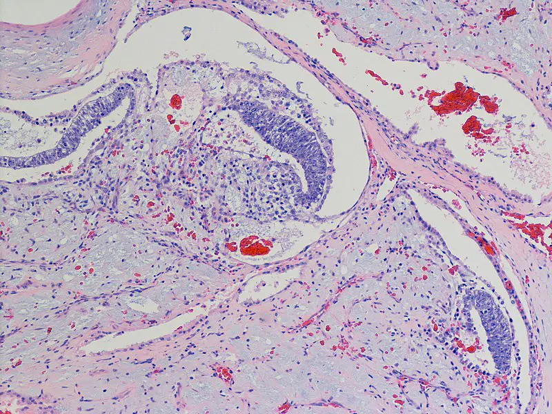 Polyembryoma of the Ovary