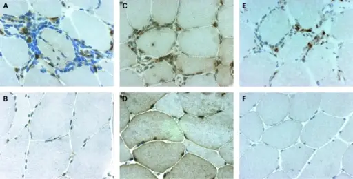 Polymyositis