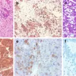 Poorly Differentiated Neoplasms of the Central Nervous System