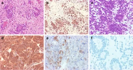 Poorly Differentiated Neoplasms of the Central Nervous System