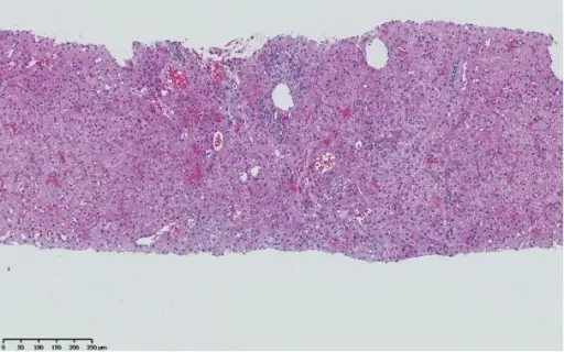 Portal Hypertension