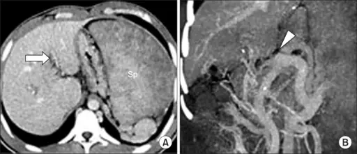 Portal Vein Obstruction