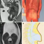 Posterior Fossa Anomalies