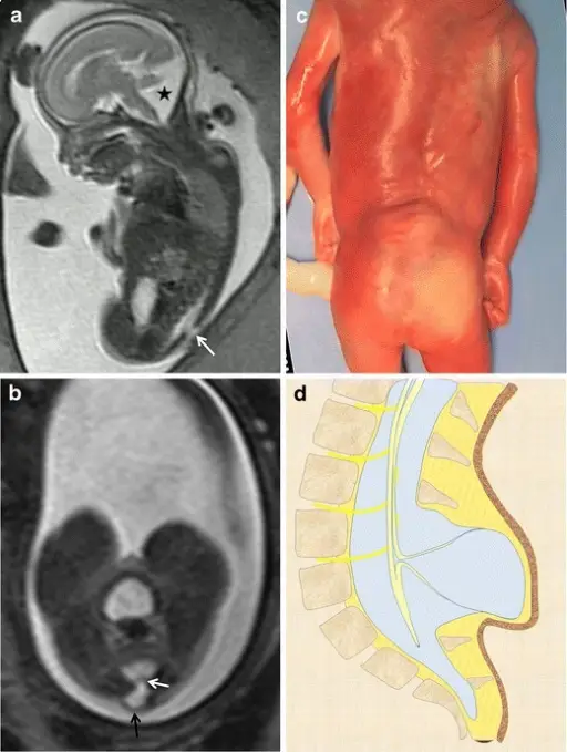 Posterior Fossa Anomalies