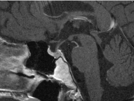 Posterior Pituitary Syndromes