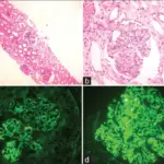 Postinfectious Glomerulonephritis