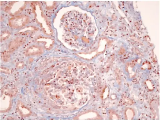 Poststreptococcal Glomerulonephritis